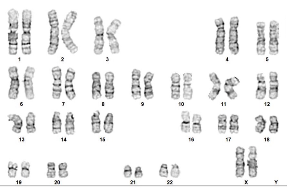 G-Band Karyotyping - KromaTiD